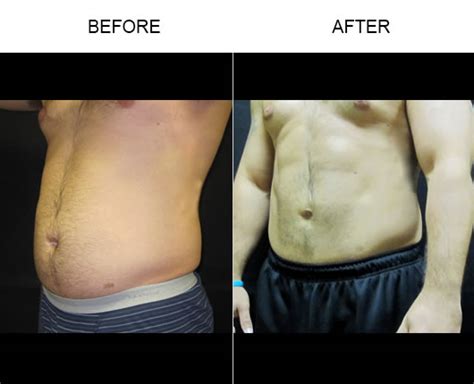 Best Male Liposuction Miami, FL 